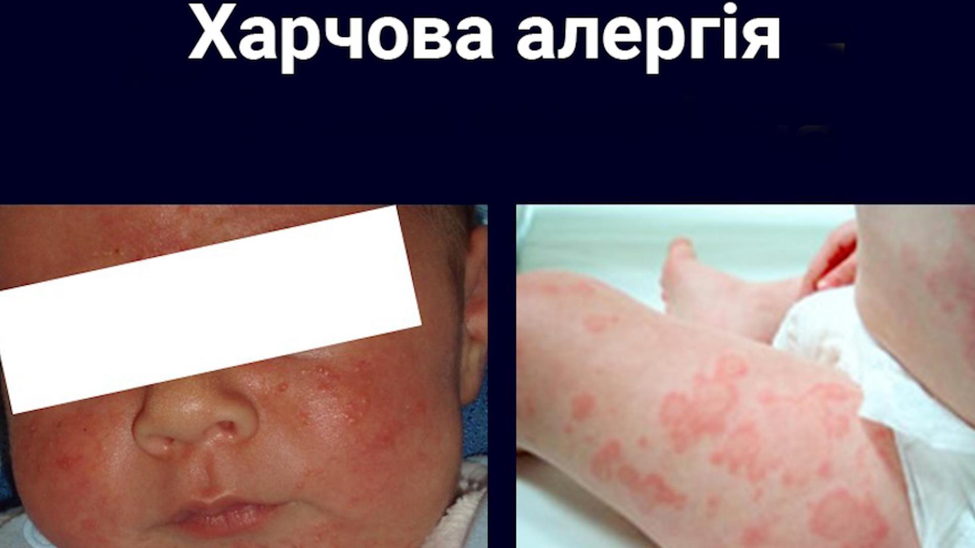 алергія у дітей висип на щічках у дитини після їжі